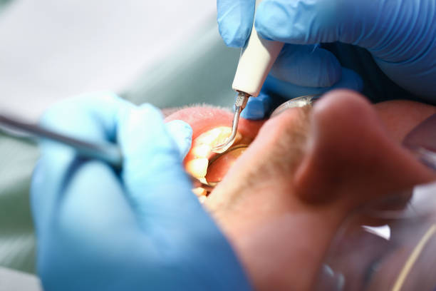 Best Chipped Tooth Repair Near Me  in Bradner, OH